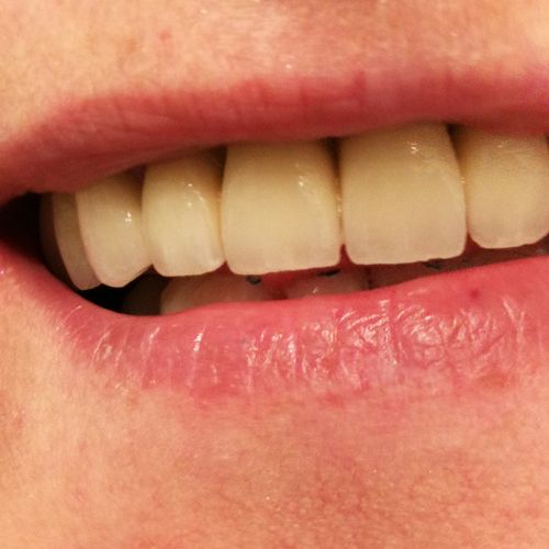 Riabilitazione superiore in metallo ceramico