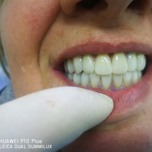 Riabilitazione superiore +inferiore con struttura in metallo avvitato + gengiva in composito e corone in Zirconia