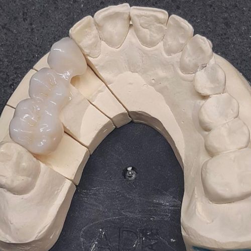 Elementi di protesi fissa realizzati interamente in zirconio