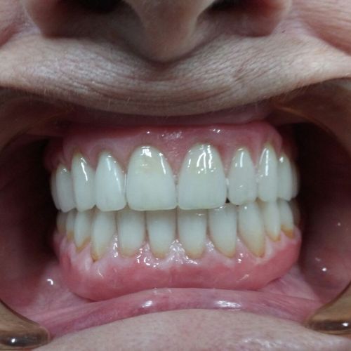 Protesi mobile totale superiore + inferiore con denti in composito e resina rosa caratterizzata.